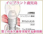 鹿児島でインプラントをするならインプラント鹿児島